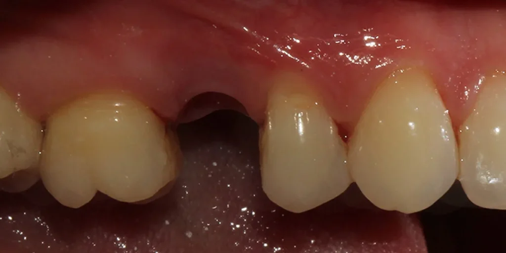 implant teeth