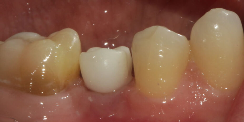 dente in zirconia senza ceramica