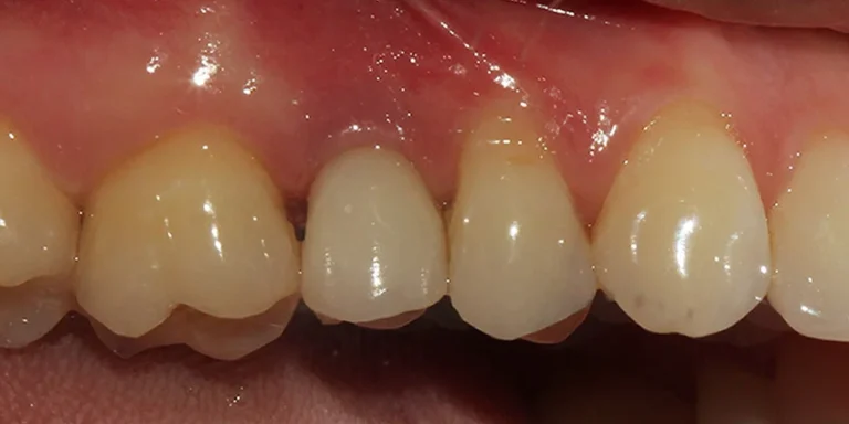 denti in zirconia dopo