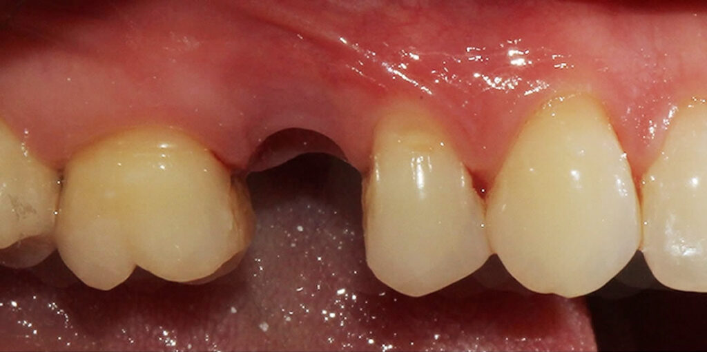 gingiva senza dente impianto