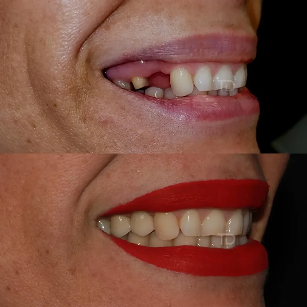 prima e dopo restaurazione di denti