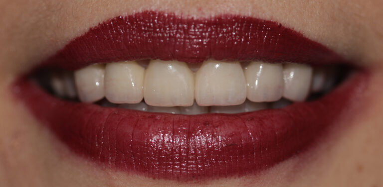 sorriso con denti in zirconia emax