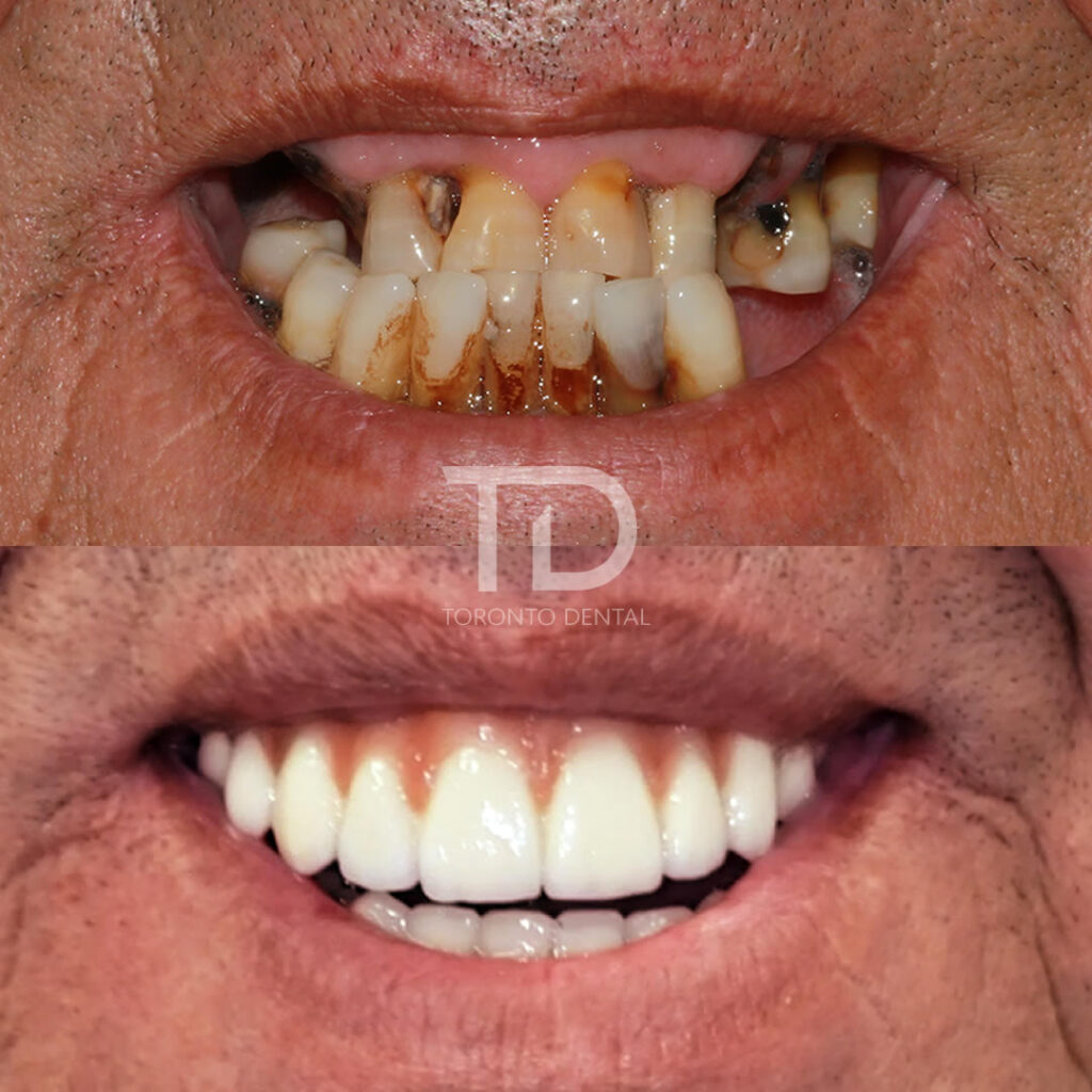 prima e dopo restaurazione impianti dentali