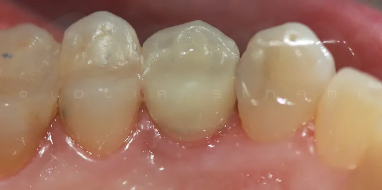 corona in zirconia sopra impianti