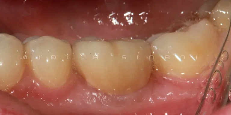 2 corone in zirconia